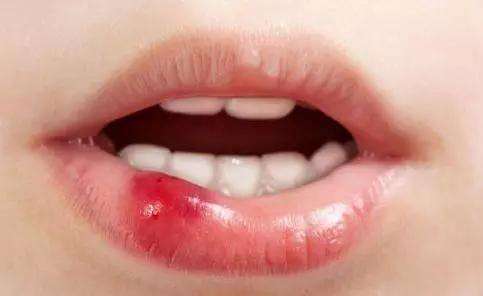 廈門玻尿酸去眼周紋醫(yī)生