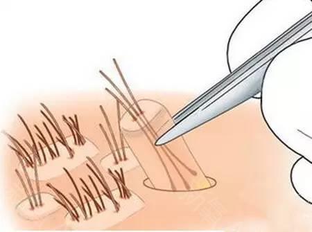 全國(guó)著名植發(fā)醫(yī)院排行榜！推薦您前往上海九院、新生等頂級(jí)機(jī)構(gòu)