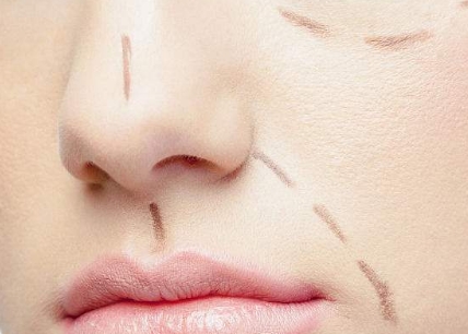 威海面部皺紋填充嗨體醫(yī)生