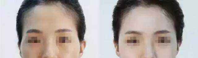 蘭州頂級整容醫(yī)院排行榜：讓你安心整形，保障你的雙眼皮手術(shù)結(jié)果！