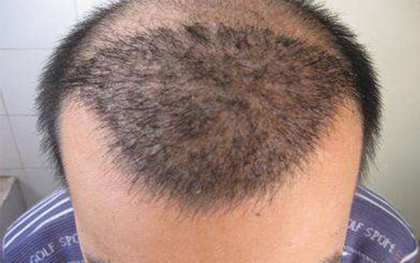 蘭州最受歡迎的近視手術(shù)醫(yī)院排名揭曉！