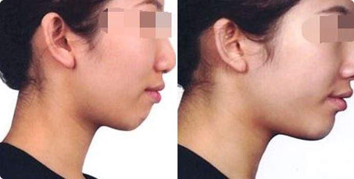 常州雙眼皮整形醫(yī)院精選六家頂級(jí)醫(yī)院，詳情提前公布！