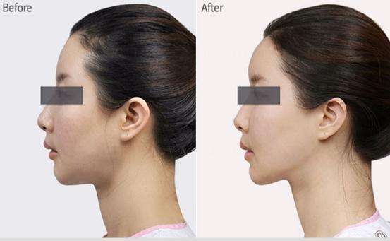 寧波哪家醫(yī)院的拉皮手術(shù)技術(shù)獨(dú)步全市？精選的前五醫(yī)院名單，藝星、薇琳等都上榜！