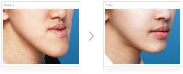 嘉興市最佳雙眼皮醫(yī)院評選揭曉！網(wǎng)友留言熱議翻墻！