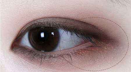 濟(jì)南5s重瞼術(shù)醫(yī)生