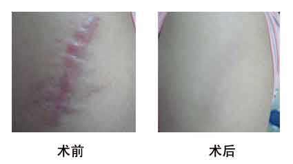 淮北光子點(diǎn)痣醫(yī)生