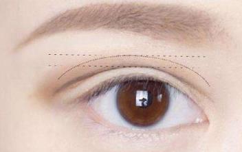 昆明眼睛細(xì)紋凹陷填充醫(yī)生