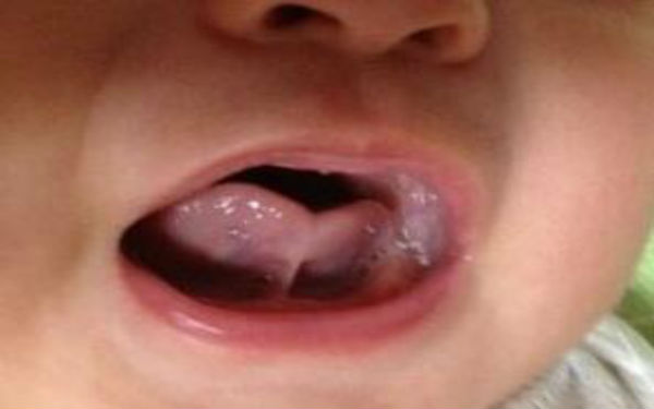 九江針雕去除頸紋醫(yī)生