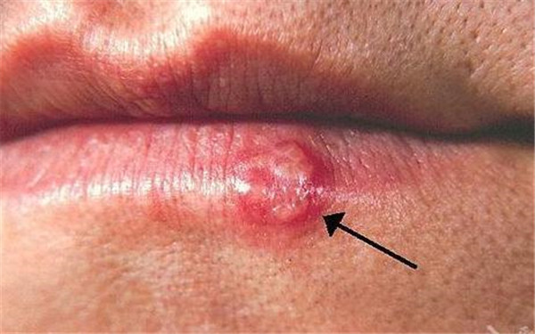 婁底熱瑪吉祛額頭紋醫(yī)生