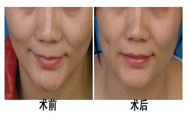 湖州雙眼皮手術(shù)機(jī)構(gòu)推薦：3家優(yōu)質(zhì)醫(yī)院完美整形，放心選擇