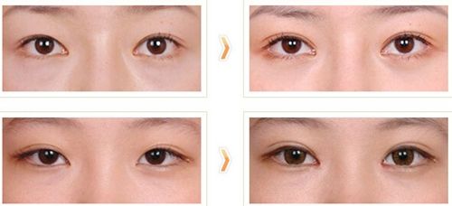 上海玻尿酸消除魚尾紋醫(yī)生