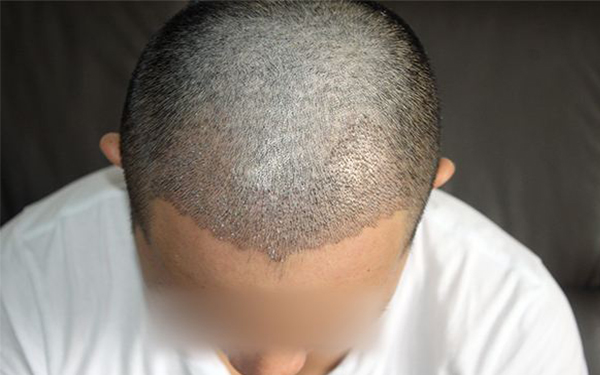 福州最佳的脂肪填充整形醫(yī)院推薦：臺(tái)江、名韓、海峽、愛美爾、格萊美！不容錯(cuò)過！