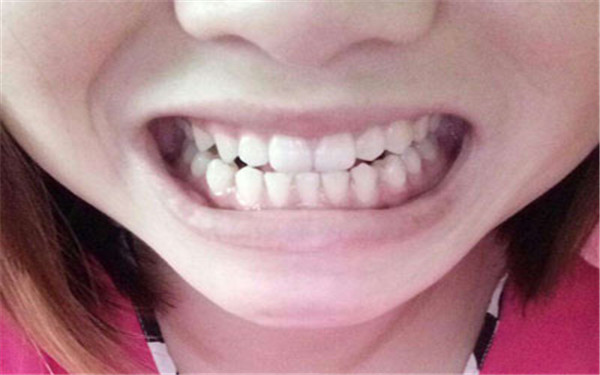 銀川秒雕去眼角紋醫(yī)生