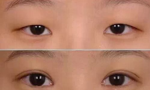 廣東肉毒素打細(xì)紋醫(yī)生