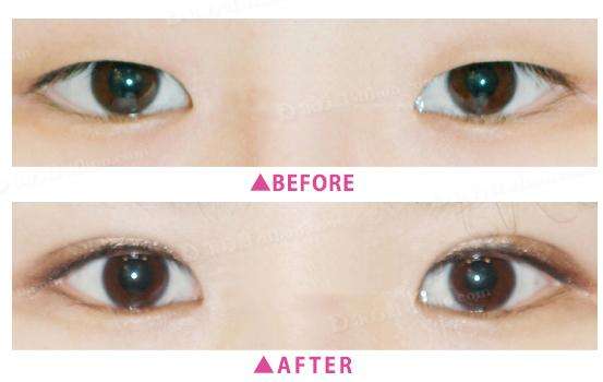 2023寧波眼瞼疤痕修復(fù)美容醫(yī)院排名揭曉！專業(yè)修復(fù)眼瞼疤痕的醫(yī)院在這！