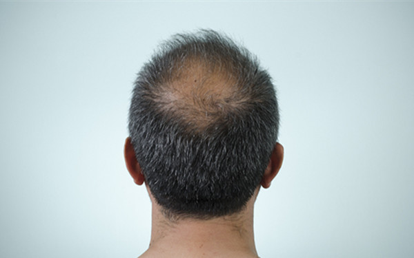 杭州哪家醫(yī)院做脈沖強(qiáng)光去痘效果好呢？