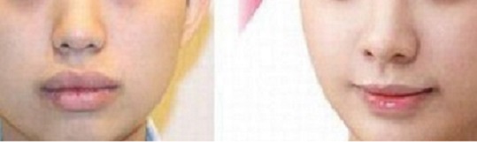 2023長沙微針去痘哪家醫(yī)院技術(shù)出眾？長沙微針去痘排名前十專業(yè)醫(yī)院揭秘！