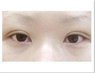 廣州有效祛斑的指導：2023年比較推崇的激光去斑醫(yī)院前十強