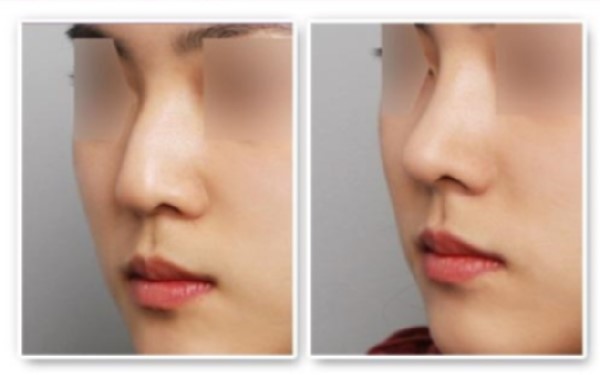 佛山地區(qū)鼻唇溝填充肉毒素醫(yī)療美容醫(yī)院推薦！2023年口碑比較好的整形醫(yī)院排名揭曉！