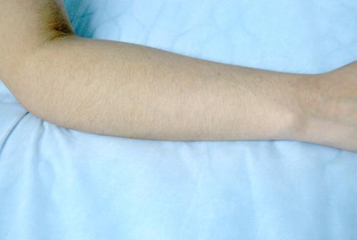 2023青島疤痕凹陷玻尿酸填充美容機(jī)構(gòu)發(fā)布全新醫(yī)療方案