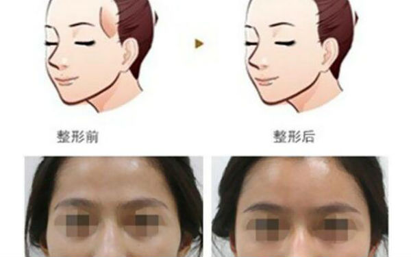 洛陽哪家醫(yī)院做木偶紋效果好？2023榜單出爐，洛陽物理去木偶紋top10佳選露面！