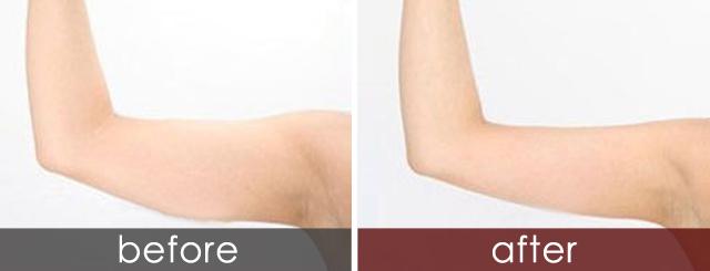 2023臺(tái)州物理去黑頭正規(guī)醫(yī)院評(píng)價(jià)揭秘！臺(tái)州物理去除黑頭哪家醫(yī)院靠譜？