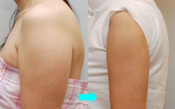 天津哪些整形美容醫(yī)院提供卓越的線雕去眼紋技術(shù)？2023比較推崇的天津線雕去眼紋前十佳整形醫(yī)院盤點(diǎn)！