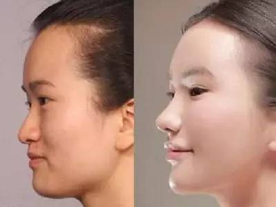 2023年，哪些上海自體脂肪面部精雕整形醫(yī)院的口碑特別好？排名榜前十值得信賴的美容整形醫(yī)院！