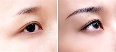 2023年北京開(kāi)眼角整形醫(yī)院排行榜TOP10公布！哪家醫(yī)院口碑比較好？