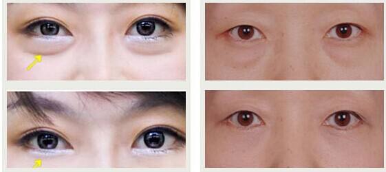 東莞有哪些效果好的川字紋除皺醫(yī)院？2023年東莞十大正規(guī)醫(yī)院排行榜出爐！