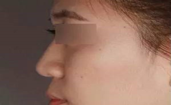 2023年?？谏漕l微針去眼角細紋哪個醫(yī)院比較好？?？谘劢羌毤y整形美容醫(yī)院排行榜綜合報道！