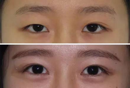 杭州駝峰鼻矯正哪家整形醫(yī)院技術(shù)獨(dú)特？2023杭州駝峰鼻矯正排名前10的醫(yī)院評(píng)測(cè)揭曉！