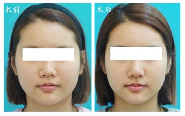 南陽哪家醫(yī)院注射鼻基底效果好？2023南陽玻尿酸注射鼻基底排行榜出爐！全城皆贊的十大醫(yī)院盤點(diǎn)！