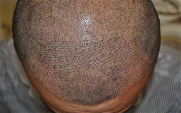 銀川口附近的10家高性價(jià)比周紋射頻去除醫(yī)院，了解一下！