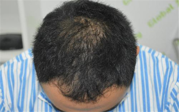 西安哪家醫(yī)院的小腿吸脂整形效果出眾？2023年排行榜前十名推薦！