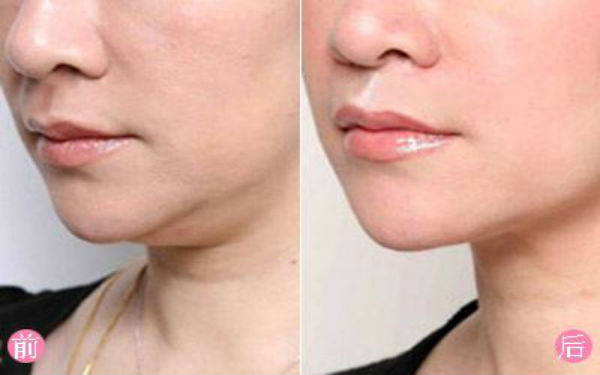 杭州消除額頭紋比較好的整形醫(yī)院排名公布，看看2023年前10位靠譜名單！