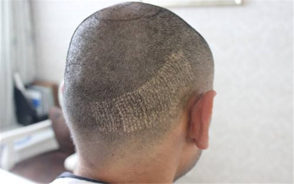 2023貴陽點陣激光祛黑頭整形醫(yī)院推薦！實力口碑評選出名！