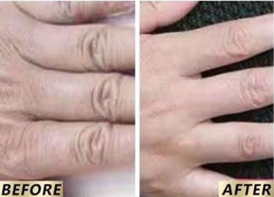 【2023非常受歡迎】南京高質(zhì)量魚尾紋激光去除醫(yī)院排行榜TOP10公布！看看有哪些值得去的！