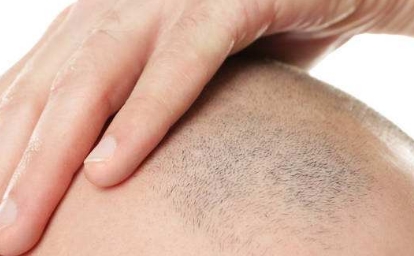 2023三亞微晶磨削點(diǎn)痣醫(yī)療美容醫(yī)院推薦，求穩(wěn)定效果好的！