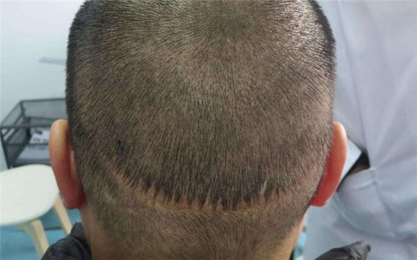 重慶十家熱門醫(yī)院推薦！2023重慶超聲去除黑眼圈美容醫(yī)院精選十強(qiáng)深度評(píng)判！