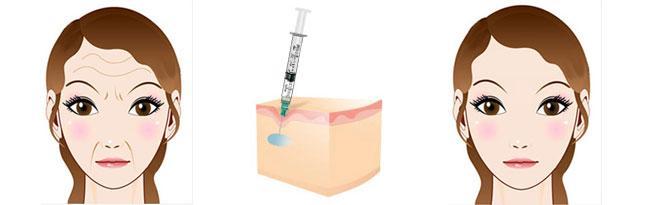 2023年溫州哪家整形醫(yī)院效果比較好？去生長紋，熱拉提推薦！