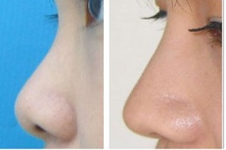 2023年海南哪家整形醫(yī)院口碑好？填充淚溝效果受網(wǎng)友推薦的醫(yī)院有哪些？