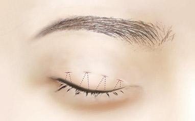 2023年武漢專業(yè)祛川字紋醫(yī)院排行榜出爐，TOP10強(qiáng)名單公布！