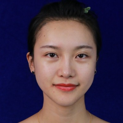 眼綜合術(shù)前VS術(shù)后，自然大眼睛值得稱贊！