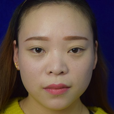 術(shù)前矮低平，術(shù)后高挺翹~肋軟骨隆鼻效果好的不得了！