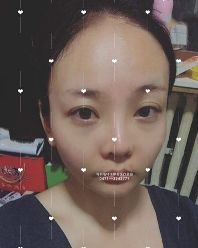 呼和浩特諾伊美王艷波自體脂肪全面部填充反饋