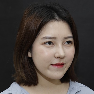 廣州美恩半肋鼻手術(shù)恢復(fù)效果反饋，主任親自操刀的效果就是贊！