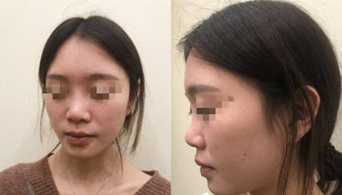 首都醫(yī)科大學(xué)附屬北京友誼醫(yī)院醫(yī)學(xué)美容中心耳軟骨隆鼻案例術(shù)前效果 首都醫(yī)科大學(xué)附屬北京友誼醫(yī)院醫(yī)學(xué)美容中心耳軟骨隆鼻案例術(shù)前效果