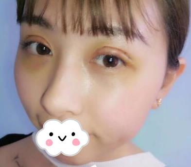 武漢亞太整形雙眼皮案例術(shù)后三天效果 武漢亞太整形雙眼皮案例術(shù)后三天效果