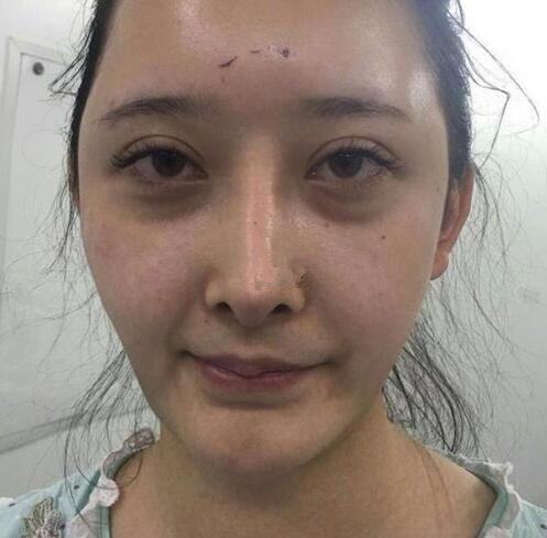 深圳陽(yáng)光全臉填充術(shù)前術(shù)后對(duì)比，說(shuō)年輕十歲不過(guò)分吧